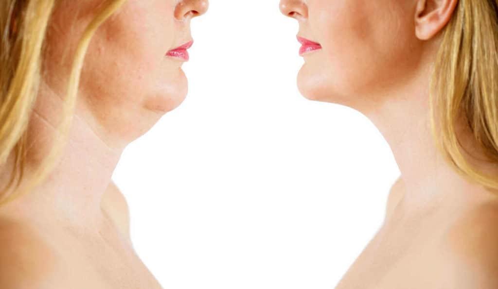 Double Chin treatment Bishop's Stortford before and after results