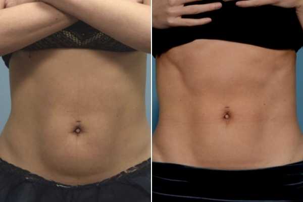 body sculpting FAQs Bishop's Stortford