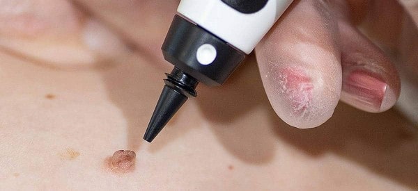 After Skin Tag Removal Bishop's Stortford