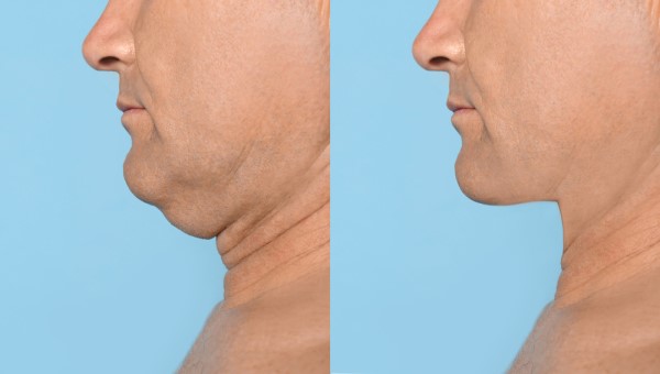 Which Non-Surgical Treatments Work Best for Jowls and Loose Skin Bishop's Stortford?