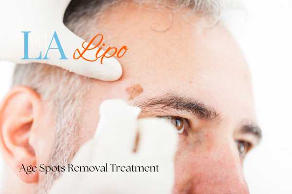 What Are the Most Effective Treatments for Age Spots Bishop's Stortford?