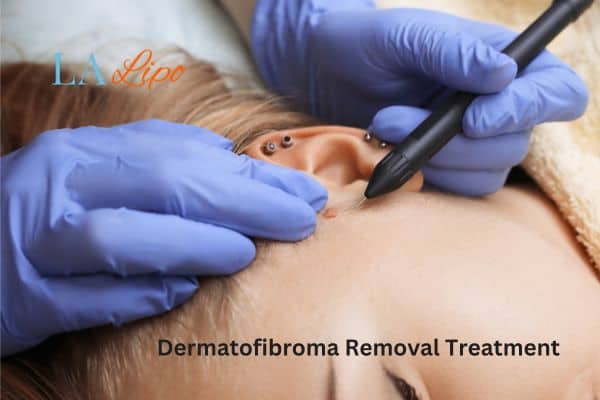Dermatofibroma Removal Treatment Bishop's Stortford