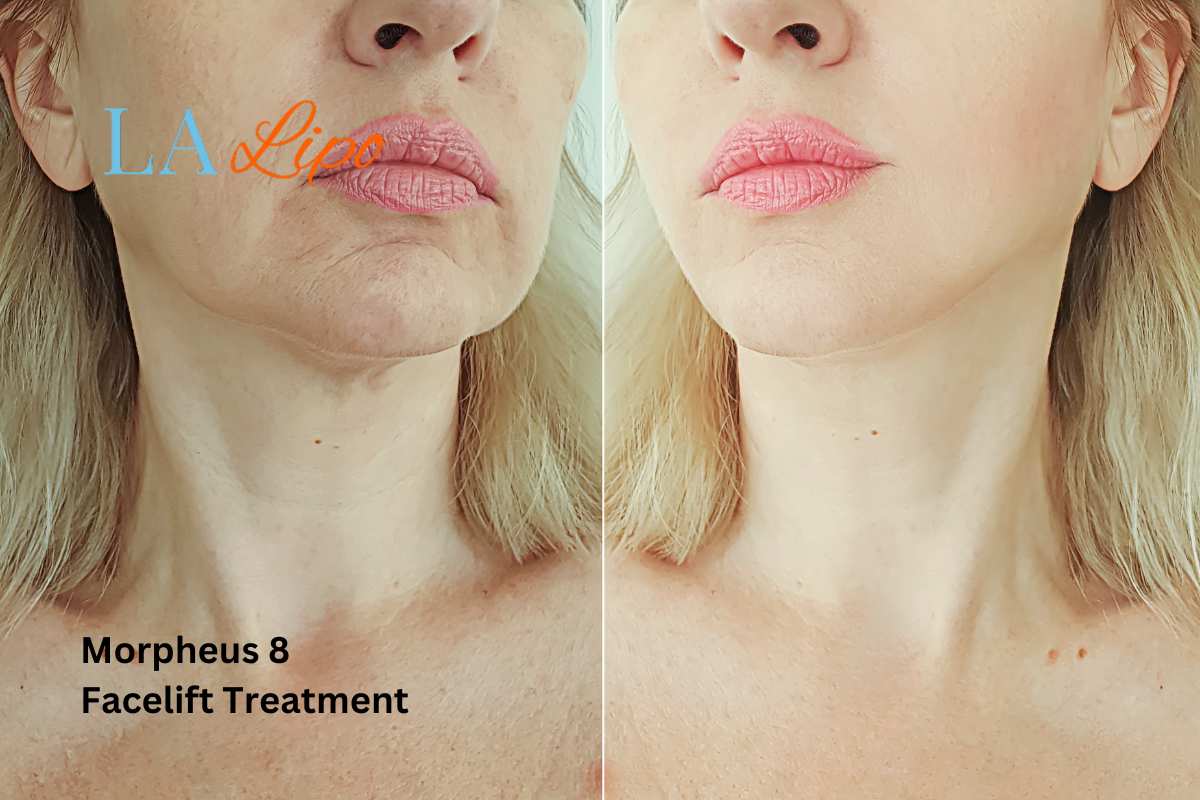 Turn back time with Morpheus8 Treatment Bishop's Stortford