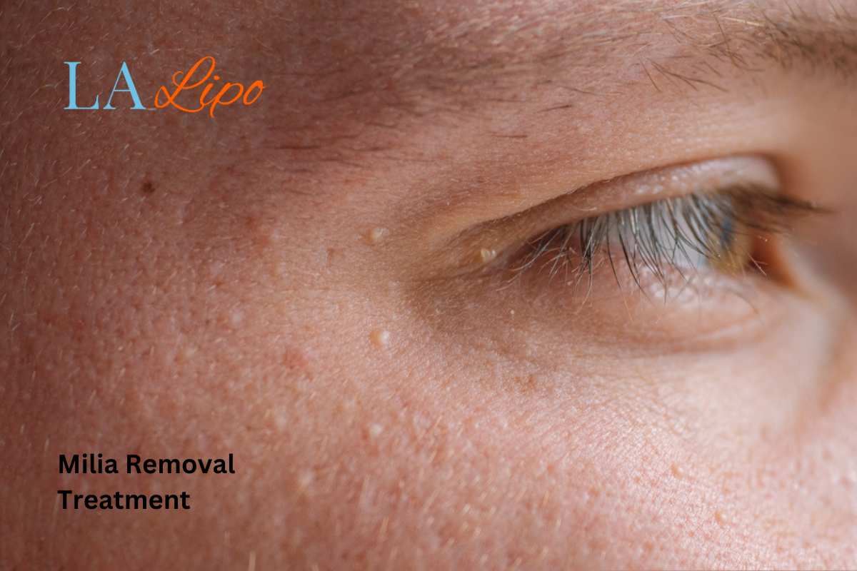 Cryopen Milia Removal: Is It the Easiest and Safest Option Bishop's Stortford?