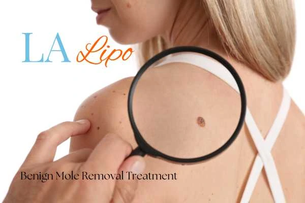 Woman having her inspection of blemish before mole removal Bishop's Stortford