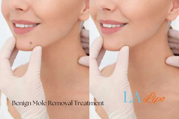 woman's before and after mole removal Bishop's Stortford results