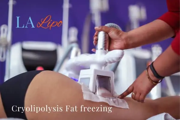 women getting fat freezing Bishop's Stortford