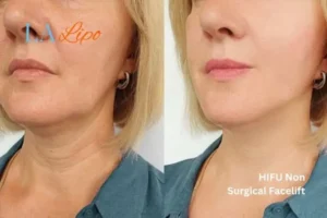 hi-fu for wrinkles Bishop's Stortford before and after results