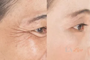 Before and after results of woman - HI-fu wrinkles reduction treatment Bishop's Stortford