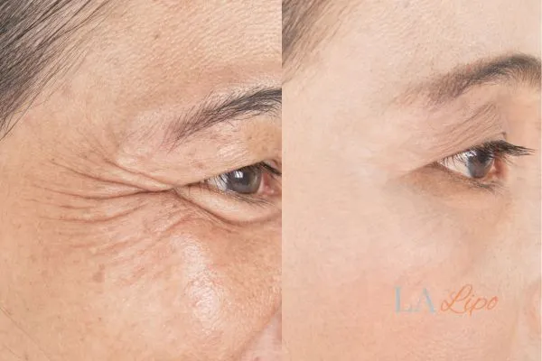 Before and after results of woman - HI-fu wrinkles reduction treatment Bishop's Stortford