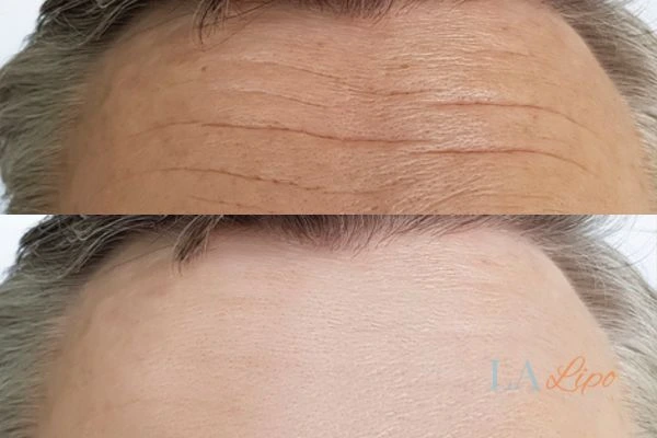 results of HIFU Bishop's Stortford on mans forehead to help reduce lines and wrinkles