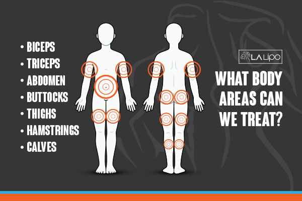 Graphic to show areas you can have LA-EMS Body Sculpting Bishop's Stortford treatment.