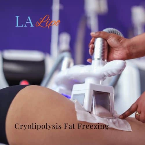 fat freezing - Cryolipolysis Bishop's Stortford