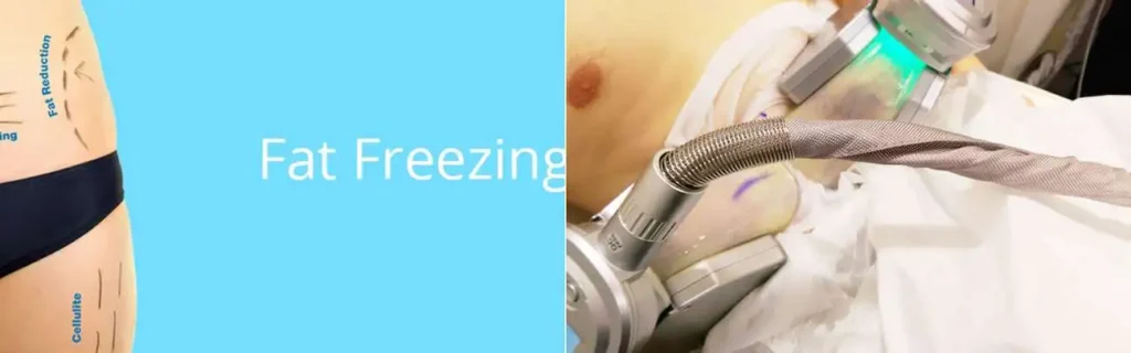 Fat freezing Bishop's Stortford on multiple areas of the body