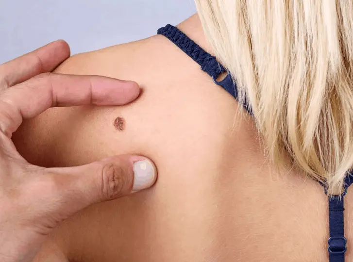 woman having mole removal Bishop's Stortford consultation before treatment.
