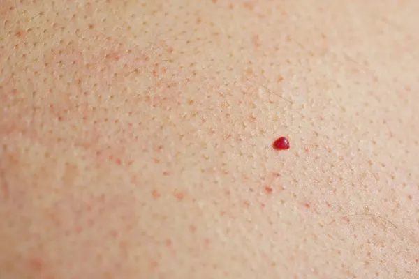 close up of a cherry angioma Bishop's Stortford