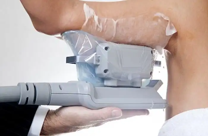 Picture of fat freezing Bishop's Stortford on the upper arms.