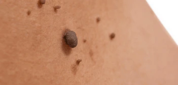 image of a skin tag Bishop's Stortford