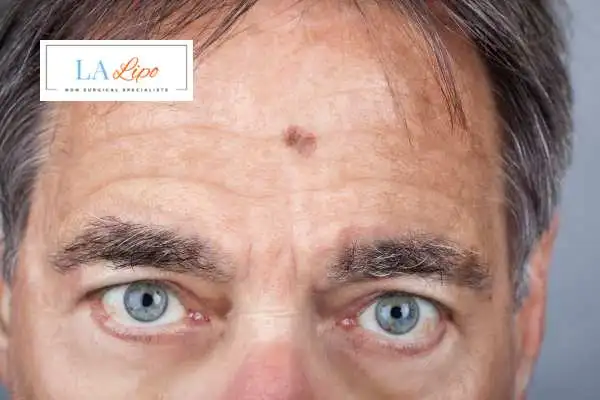 Solar Lentigo Removal Bishop's Stortford image of man with mark on his forehead