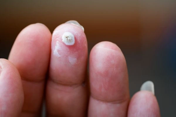 wart on person finger - cryotherapy to treat from LA LIPO Bishop's Stortford
