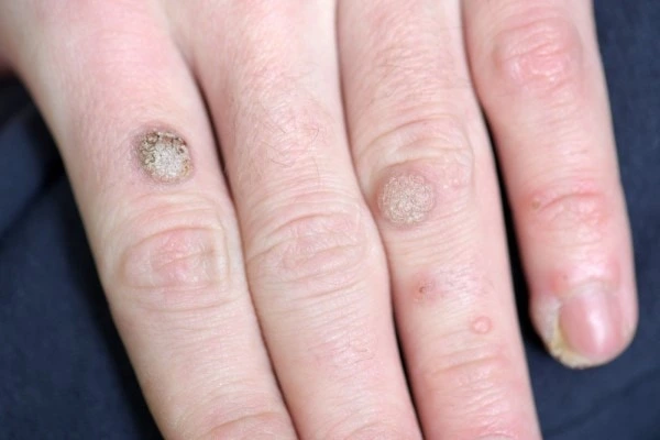 photo of warts on person hand - see wart removal Bishop's Stortford from LA LIPO