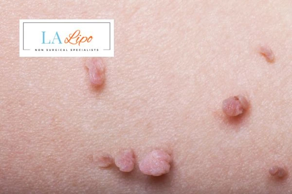 Does cryopen skin tag removal Bishop's Stortford hurt? Find out now call our team today!
