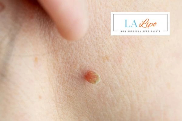 Book skin tag removal Bishop's Stortford today speak to our team now!