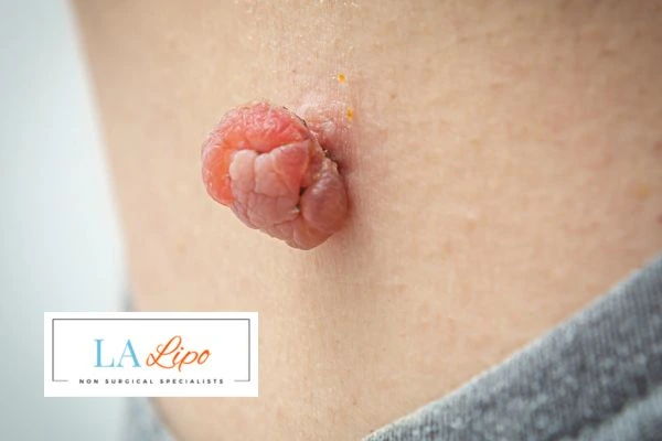 Interested in skin tag removal Bishop's Stortford? Concerned about the pain? Find out more today!