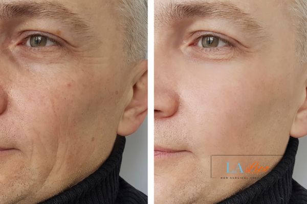 See the amazing results of Morpheus8 Treatment Bishop's Stortford!