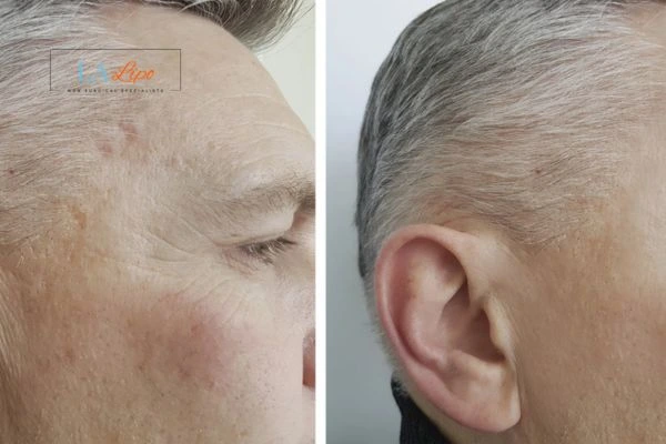 Mens Before & After Morpheus 8 Results Bishop's Stortford