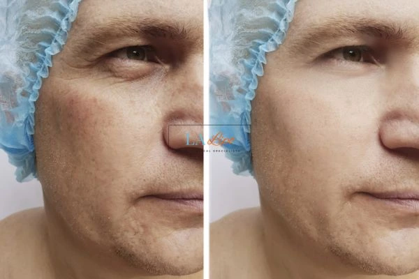 Before and after Morpheus 8 Results Bishop's Stortford