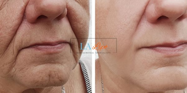 Older lady deeper wrinkle reduction - LA LIPO Morpheus 8 Results Bishop's Stortford