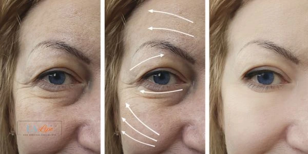 Amazing eye lift Morpheus 8 results Bishop's Stortford