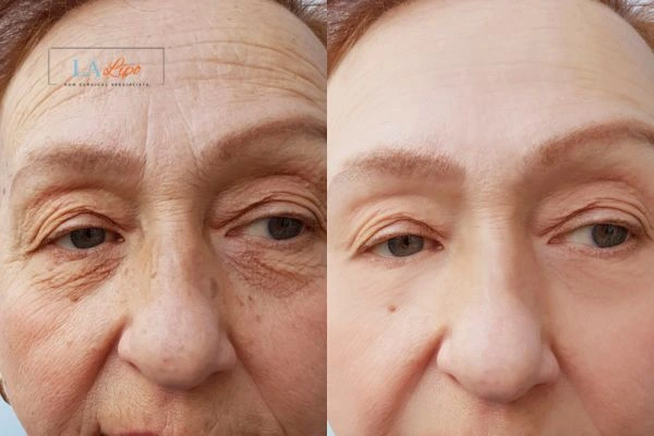 The powerful benefits of Morpheus8 Treatment Bishop's Stortford - Call Our team today!
