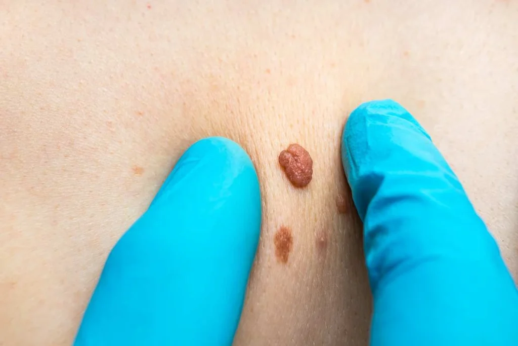LA LIPO Cryopen Lesion Removal Prices Bishop's Stortford