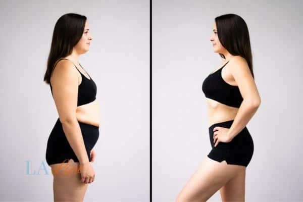 Picture of womans before and after using LA-EMS body sculpting to improve her core strength Bishop's Stortford