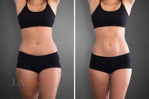 before and after results of non-surgical treatment to help a woman's body image and mental health Bishop's Stortford