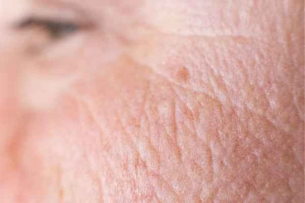 close up picture of a woman's face showing an age spot Bishop's Stortford