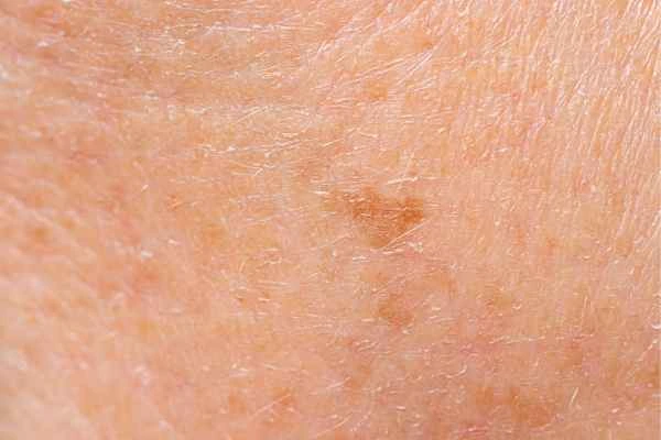 close up picture of age spots Bishop's Stortford