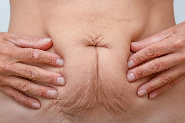 Image of a woman's stomach with loose skin - example of skin tightening Bishop's Stortford options