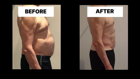 What Symptoms Can Diastasis Recti Cause in Men? Weak Core, Back Pain and Poor Posture Bishop's Stortford